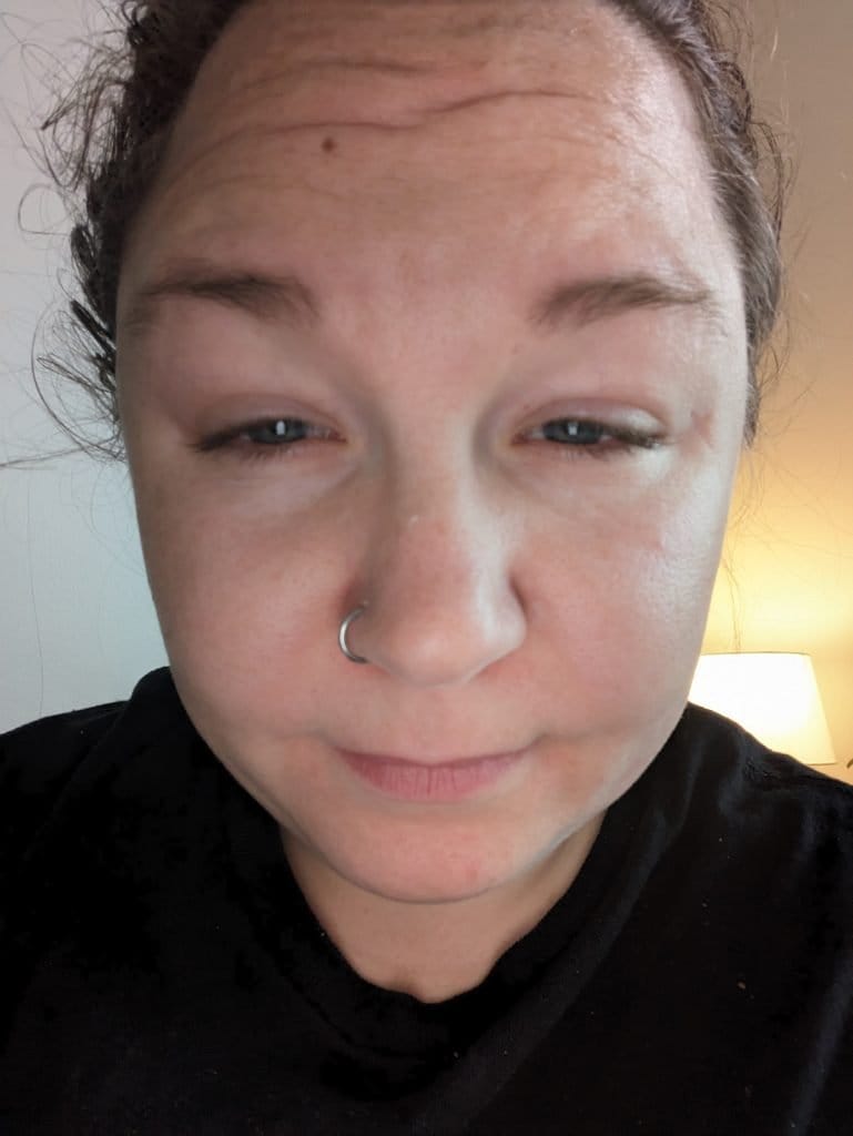 Photo of author, inflamed with swollen eyes, chronic fatigue, brain fog during the medical malpractice of the iodine poisoning.